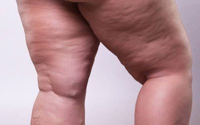 lipedema