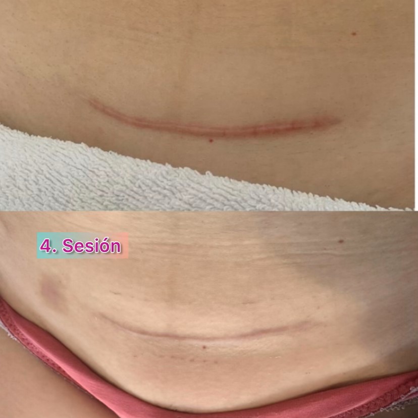 Recuperarse de una cesárea