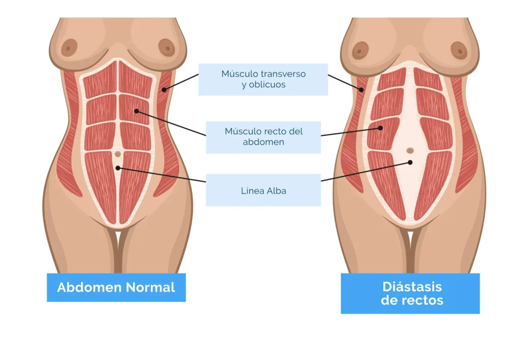 diastasis abdominal ejercicios