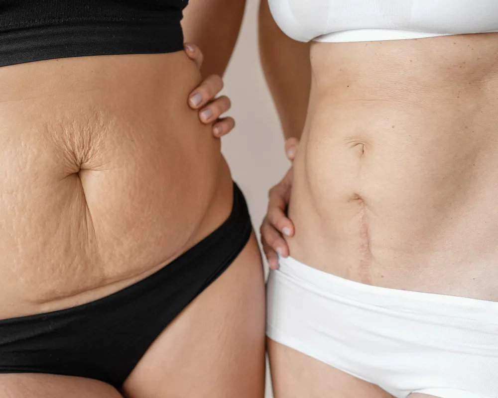 cicatrices abdominales