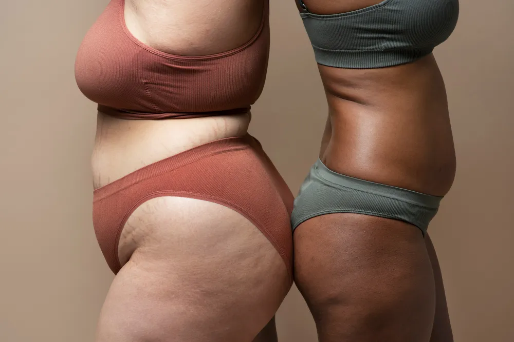 lipedema tratamiento