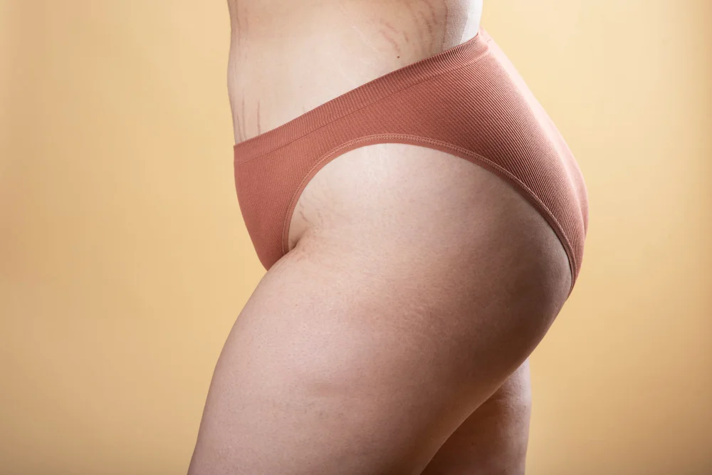 varices vulvares que son
